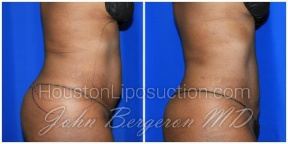 Liposuction Before & After Patient #1993