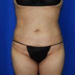 Liposuction Before & After Patient #2001