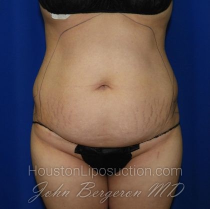 Liposuction Before & After Patient #2001