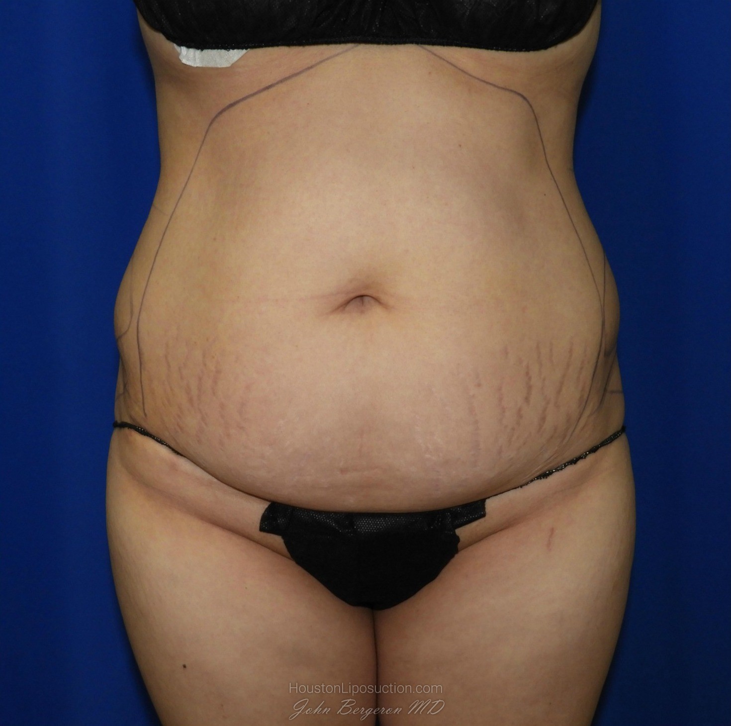 Liposuction Before & After Patient #2001