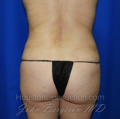 Liposuction Before & After Patient #2001