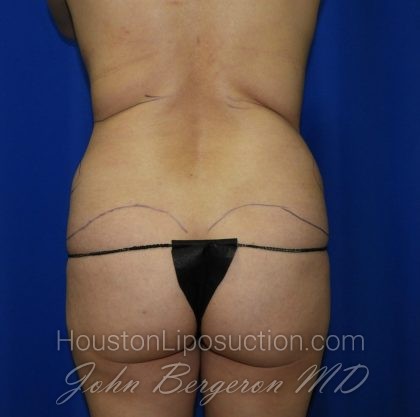 Liposuction Before & After Patient #2001