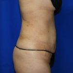 Liposuction Before & After Patient #2001