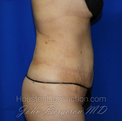 Liposuction Before & After Patient #2001