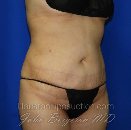Liposuction Before & After Patient #2001