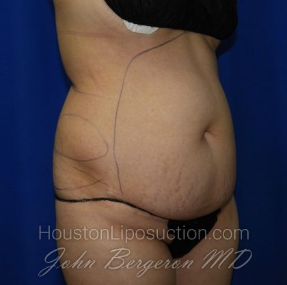 Liposuction Before & After Patient #2001