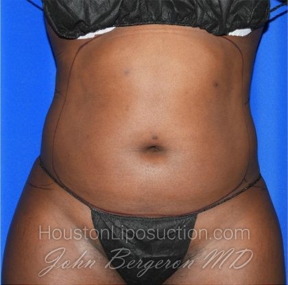 Liposuction Before & After Patient #2030