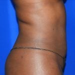 Liposuction Before & After Patient #2030