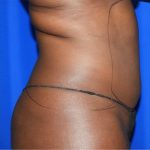 Liposuction Before & After Patient #2030