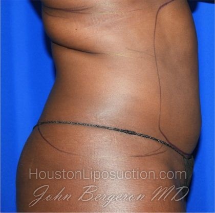 Liposuction Before & After Patient #2030