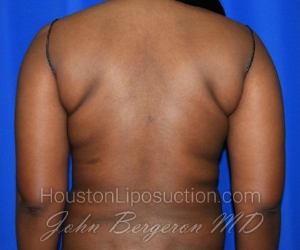 Liposuction Before & After Patient #1998