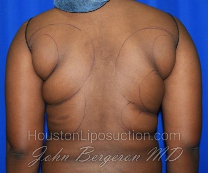 Liposuction Before & After Patient #1998