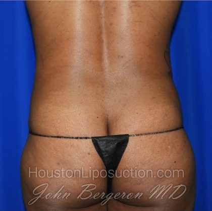 Liposuction Before & After Patient #2101