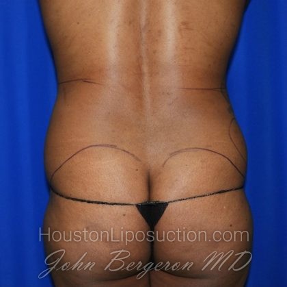 Liposuction Before & After Patient #2101