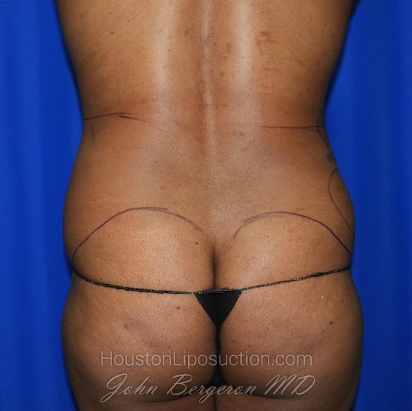 Liposuction Before & After Patient #2101