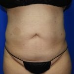 Liposuction Before & After Patient #2167