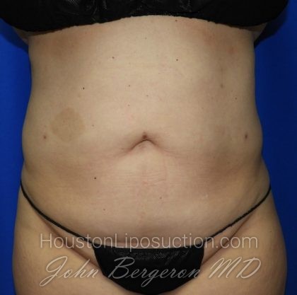 Liposuction Before & After Patient #2167