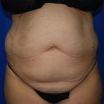 Liposuction Before & After Patient #2167