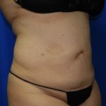 Liposuction Before & After Patient #2167