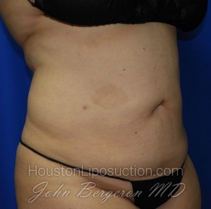 Liposuction Before & After Patient #2167
