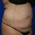 Liposuction Before & After Patient #2167