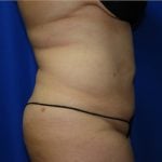 Liposuction Before & After Patient #2167