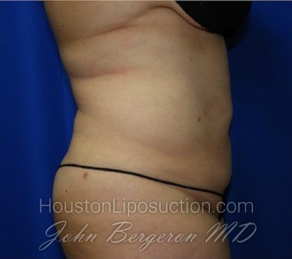 Liposuction Before & After Patient #2167