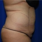 Liposuction Before & After Patient #2167