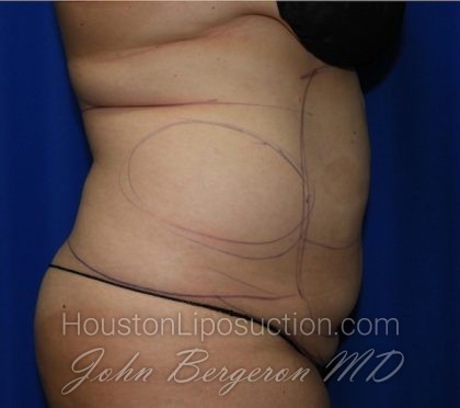 Liposuction Before & After Patient #2167