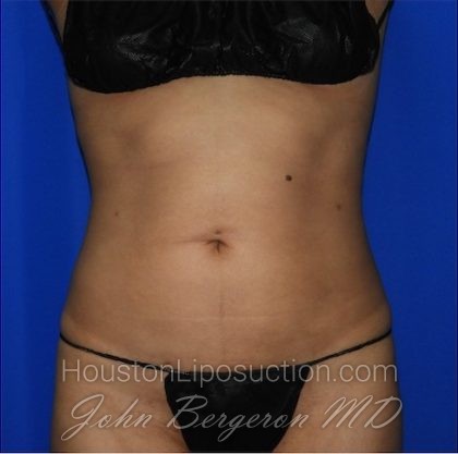 Liposuction Before & After Patient #2211