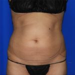 Liposuction Before & After Patient #2211