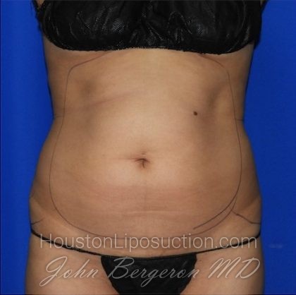 Liposuction Before & After Patient #2211