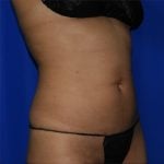 Liposuction Before & After Patient #2211