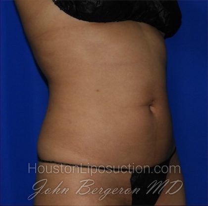 Liposuction Before & After Patient #2211