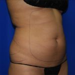 Liposuction Before & After Patient #2211