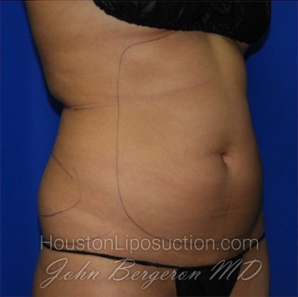 Liposuction Before & After Patient #2211