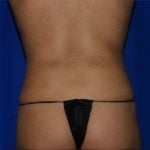 Liposuction Before & After Patient #2211