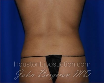 Liposuction Before & After Patient #2211