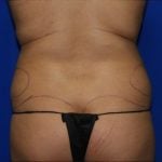 Liposuction Before & After Patient #2211