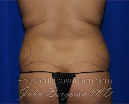 Liposuction Before & After Patient #2211