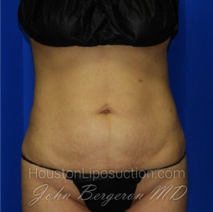 Liposuction Before & After Patient #2237