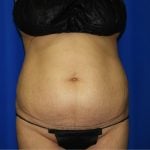 Liposuction Before & After Patient #2237