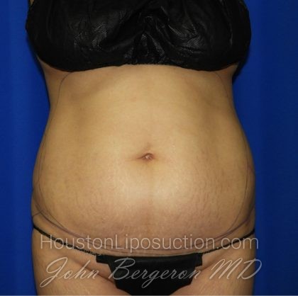 Liposuction Before & After Patient #2237