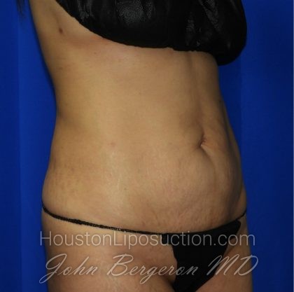 Liposuction Before & After Patient #2237