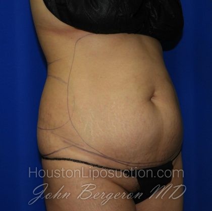 Liposuction Before & After Patient #2237