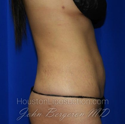 Liposuction Before & After Patient #2237