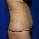 Liposuction Before & After Patient #2237