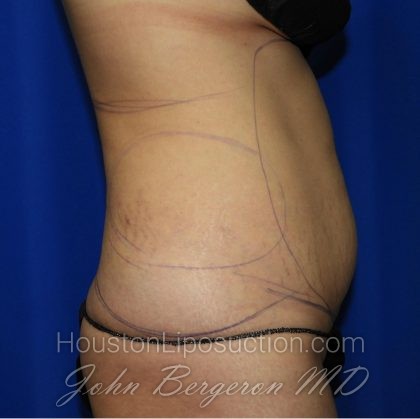 Liposuction Before & After Patient #2237