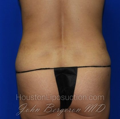 Liposuction Before & After Patient #2237