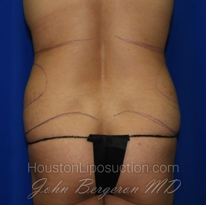 Liposuction Before & After Patient #2237
